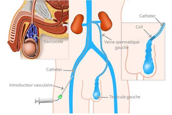 Embolisation varicocele